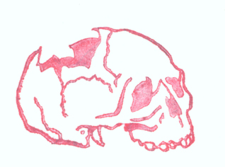 Broken skull